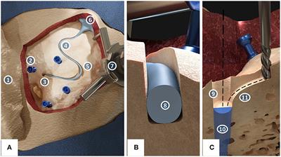 Robotic Milling of Electrode Lead Channels During Cochlear Implantation in an ex-vivo Model
